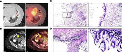 Case Report: An Unusual Case of Pulmonary Metastatic Adenocarcinoma From Low-Grade Appendiceal Mucinous Neoplasms